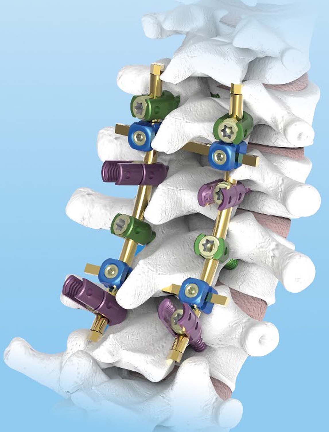 Система для транспедикулярної фіксації хребта (6 гвинтів) UMP